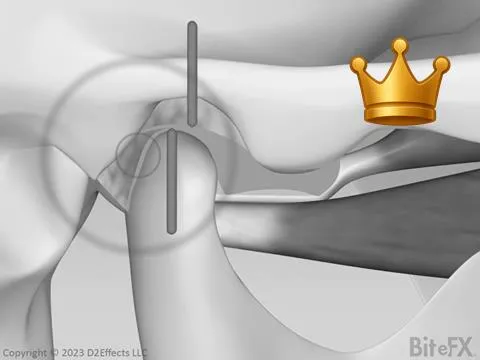 TMJ Disc Distortion V3