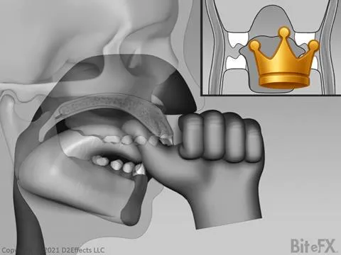 Thumbsuck'g High Palate