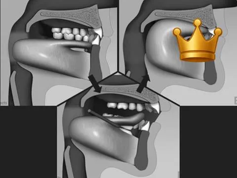 Tongue Tie + Frenectomy