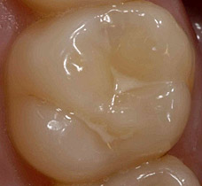 Molar with moderate wear