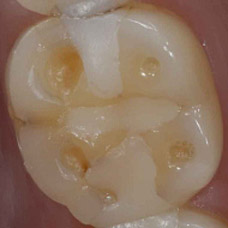 Molar with severe wear