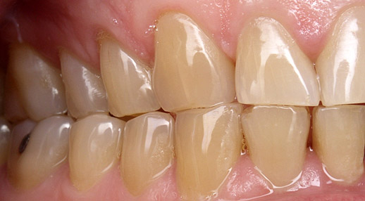 Teeth showing lack of canine guidance.