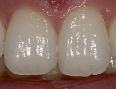 Healthy incisors