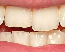 Incisors with moderate notched wear