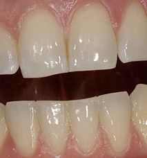 Incisors with moderate wear
