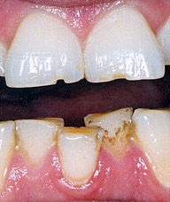 Incisors with severe notched wear