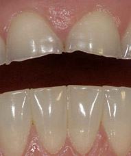 Incisors with severe wear