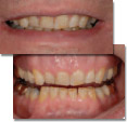 Treatment plan patient showing extensive tooth wear resulting in unhappiness with smile