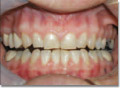 Patient with full dental bridge -occlusally incorrect causing neuromuscular and tooth pain
