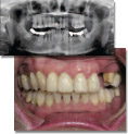 Multiple replacement and failures of bridge with loss of teeth -unrecognized severe occlusal disease from previous dentist.