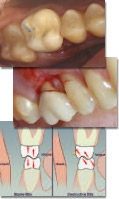 Poor equilibration and inappropriate placement of crown resulting in facial bone loss.