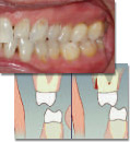 Occlusal wear and multiple abfractions explained using BiteFX animations.