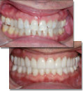 Before and after photos showing long term success of full mouth restoration with correct occlusal analysis and treatment planning.